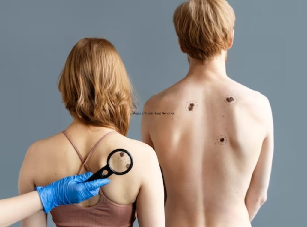 Treatment for moles and skin tags