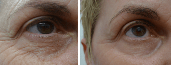 CO2-at-Shadi-Danin-Medi-Spa-2