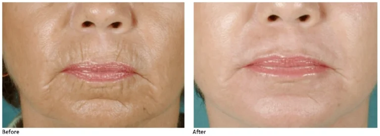 CO2-at-Shadi-Danin-Medi-Spa-3