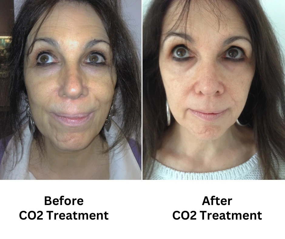 CO2 Laser Treatment