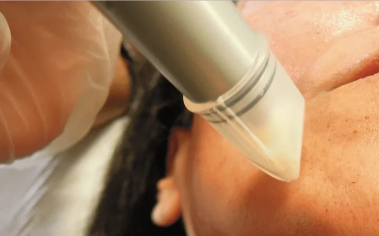 micro-needling-nanopore