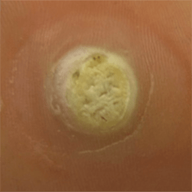 Plantar wart