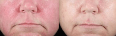 rosacea at shadi danin