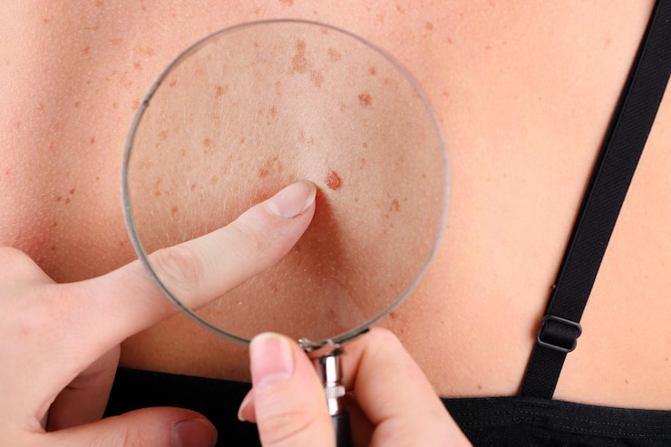 Seborrheic Keratoses Removal