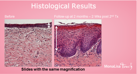 Monalisa touch histology
