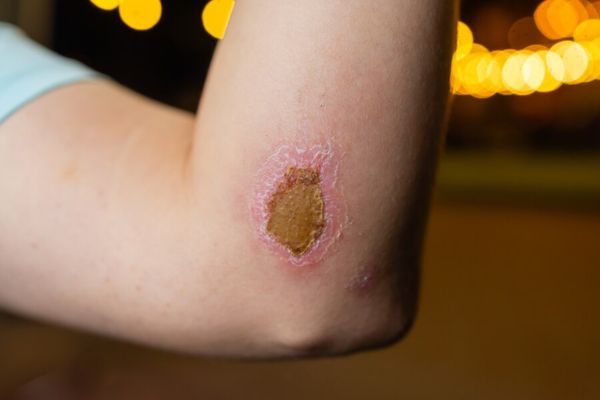 Warts-and-Verruca-treatment