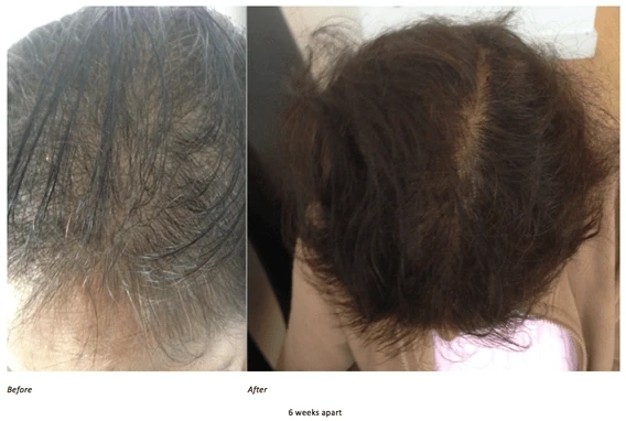 hairloss-women