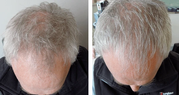 laser hair restoration