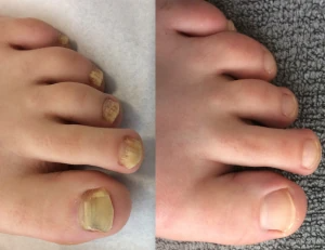 nail fungus