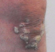psoriasis-before